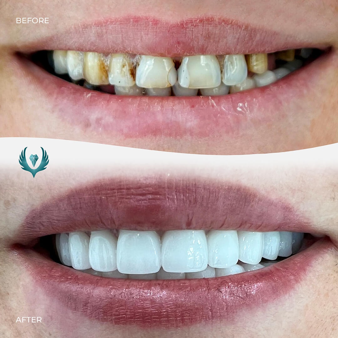 veneers-turkey-before-after-smile.jpg