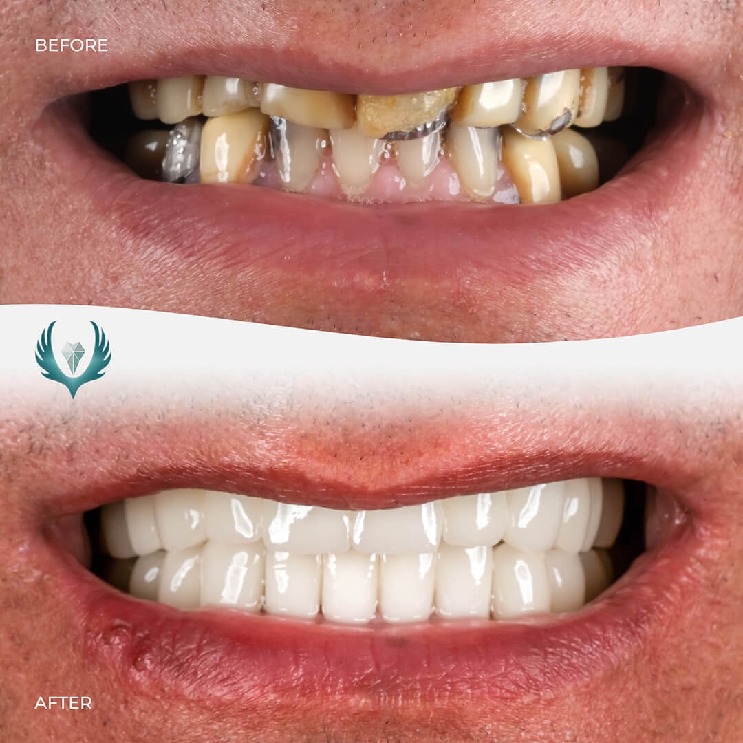 andepol-antalya-veneers-before-after-smile.jpg