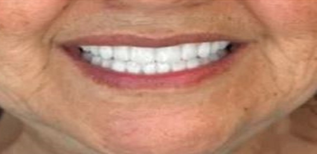dentures-after-2.jpg