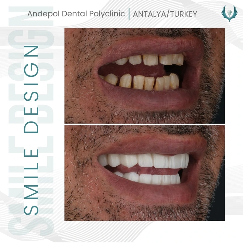 laminate-veneers-before-after-metin-1.webp