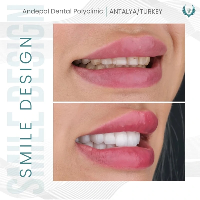 holywood-smile-before-after-talya-3.webp
