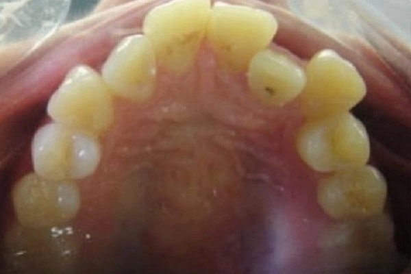 wisdom-tooth-incisor-stage.jpg