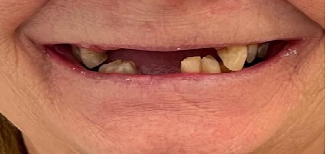 dentures-before-1.jpg