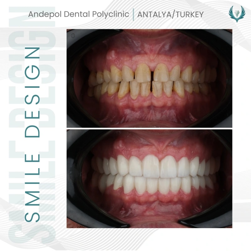 laminate-veneers-before-after-metin-2.webp