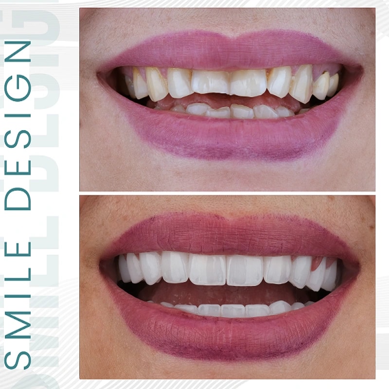 smile-design-sallah-1.webp