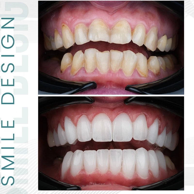 smile-design-sallah-2.webp