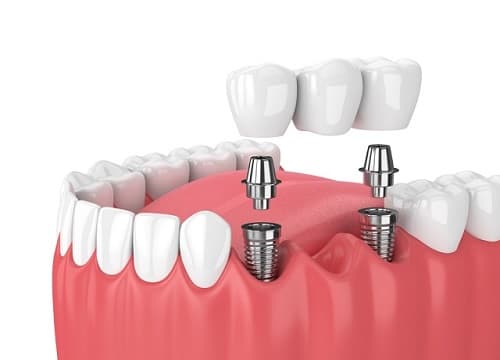 Implant Supported Bridge