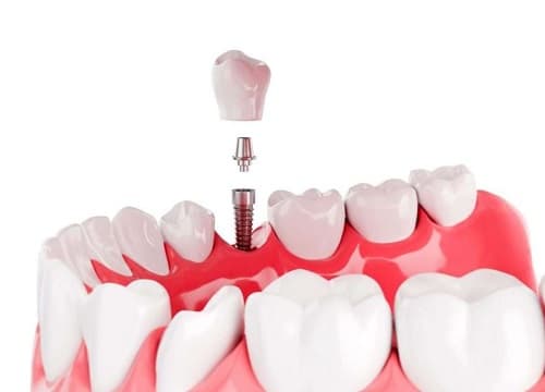 Implant Supported Prosthesis