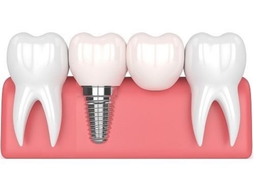 1 Dental Implant for 2 Teeth