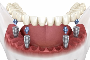 All on 4 İmplant