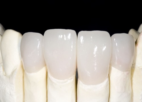 All on 4 Zirconia Bridge