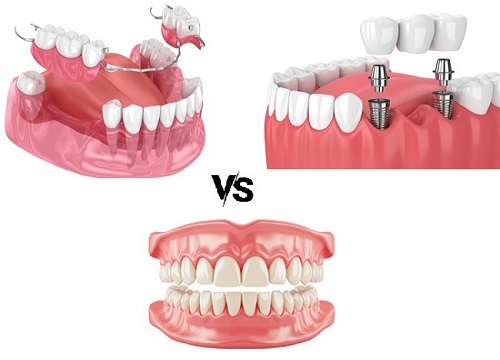 Cheap Options for Missing Teeth