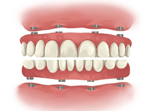 Full Mouth Dental Implants Turkey