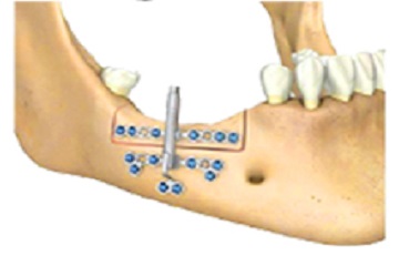 Distraksiyon Osteogenezi