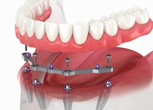 Full Denture Implants