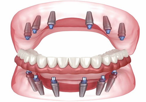 Turkey Teeth Cost