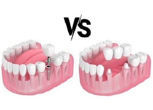 Dental Implants vs Bridges