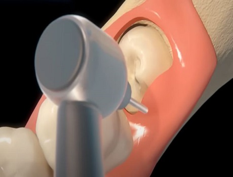 wisdom tooth tissue cutting