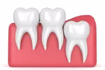 wisdom teeth vertical eruption