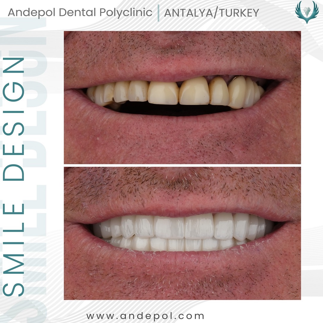 all on 4 implant diş öncesi sonrası