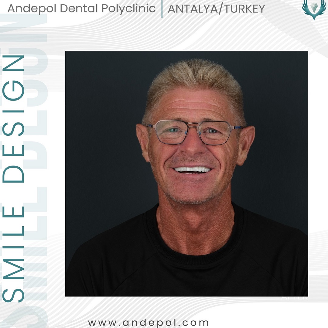 all on 4 implant diş sonrası