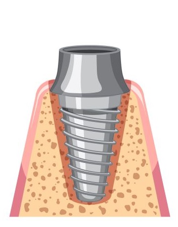 implant abutment aşaması 3