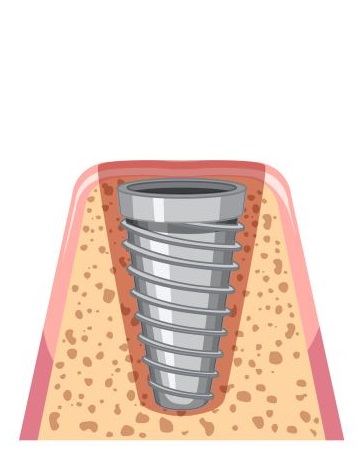 implant iyilesme aşaması 2