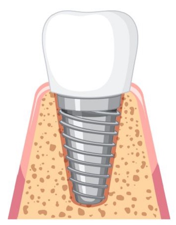 implant kuron aşaması 4