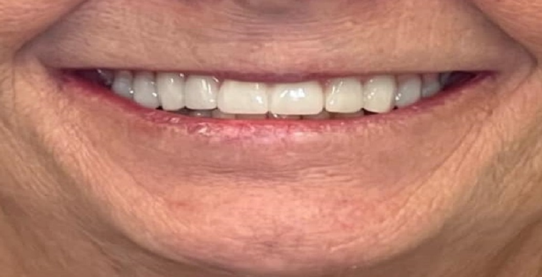 dentures after